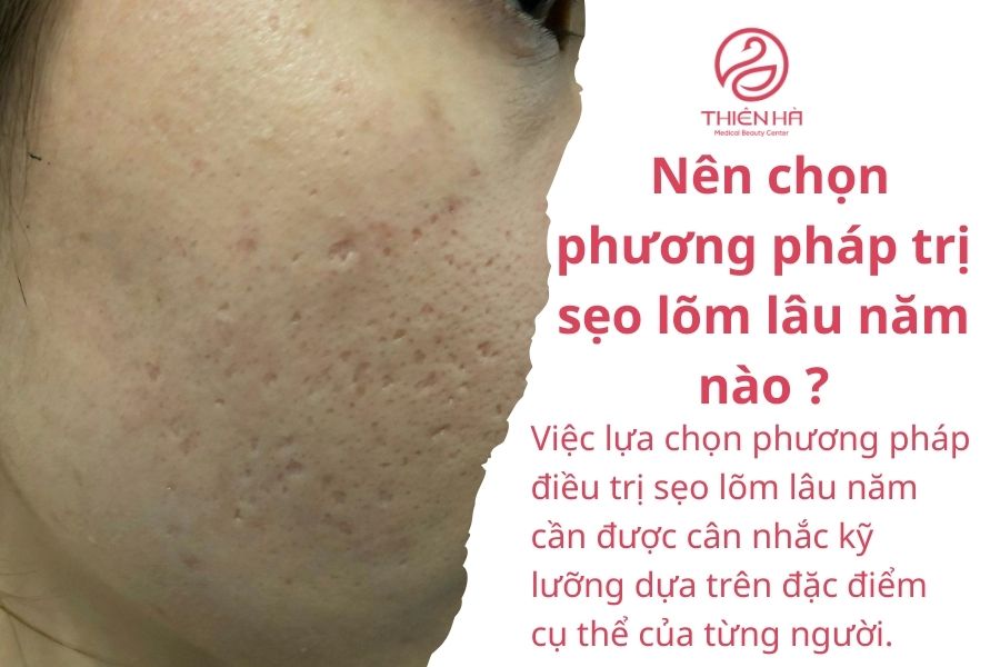 Sẹo lõm lâu năm có trị được không? Quy trình điều trị tại Thiên Hà 5 Nên chọn phương pháp trị sẹo lõm lâu năm nào