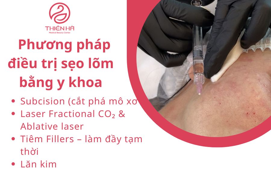Sẹo lõm lâu năm có trị được không? Quy trình điều trị tại Thiên Hà 3 Các phương pháp điều trị sẹo lõm lâu năm hiệu quả