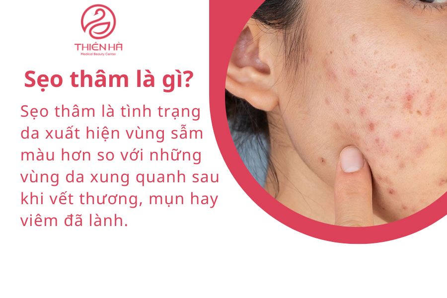 Sẹo thâm là gì?