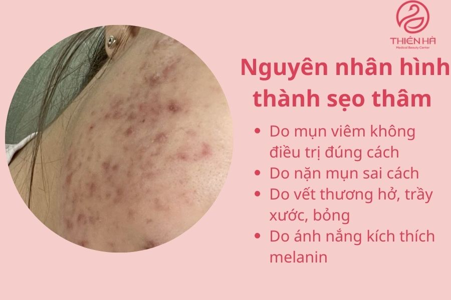 Nguyên nhân hình thành sẹo thâm