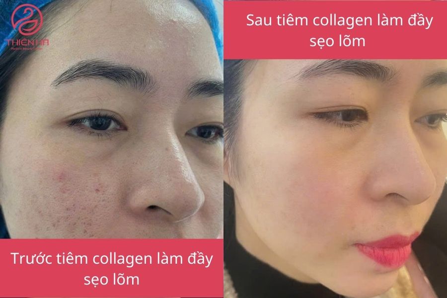 Tiêm collagen làm đầy sẹo lõm: hiệu quả nhanh, an toàn, kéo dài 2 Kết quả sau khi khách hàng tiêm collagen làm đầy sẹo lõm