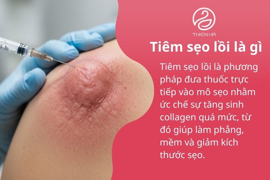 Tiêm sẹo lồi là gì 