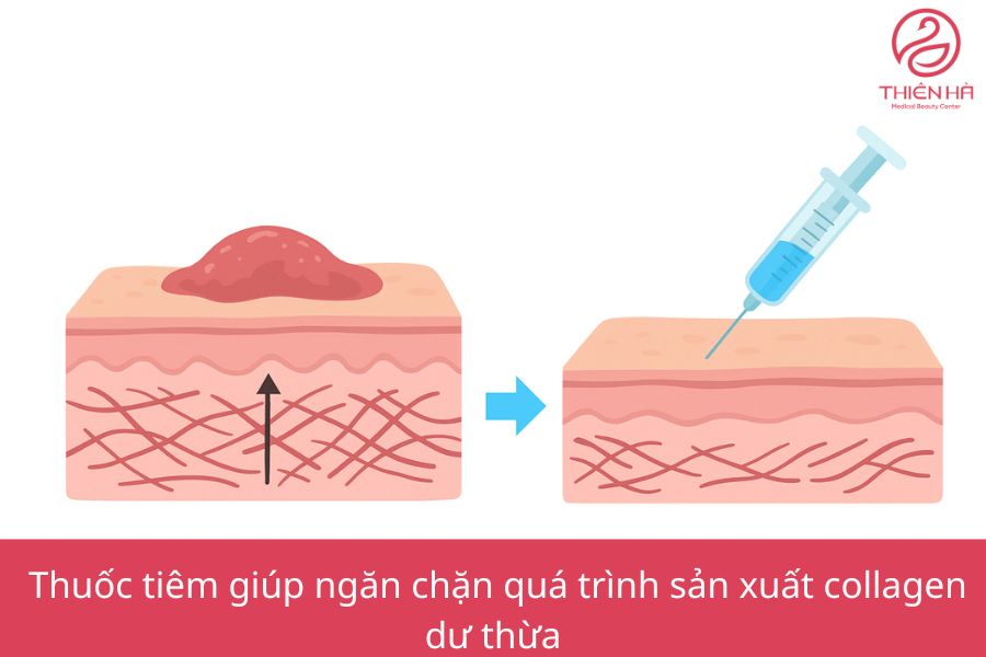 Cơ chế tác dụng của tiêm sẹo lồi