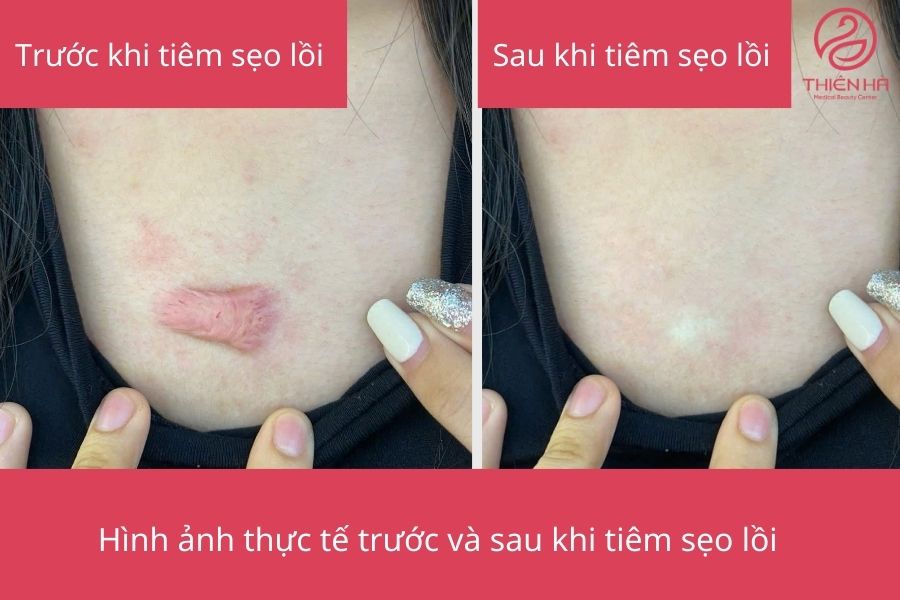 Kết quả sau tiêm sẹo lồi 
