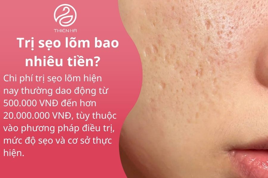 Trị sẹo lõm bao nhiêu tiền? Xem ngay bảng giá chi tiết mới nhất 1 Trị sẹo lõm bao nhiêu tiền?
