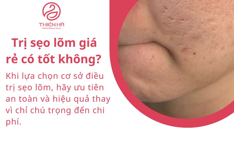 Trị sẹo lõm bao nhiêu tiền? Xem ngay bảng giá chi tiết mới nhất 3 Trị sẹo lõm giá rẻ có tốt không?