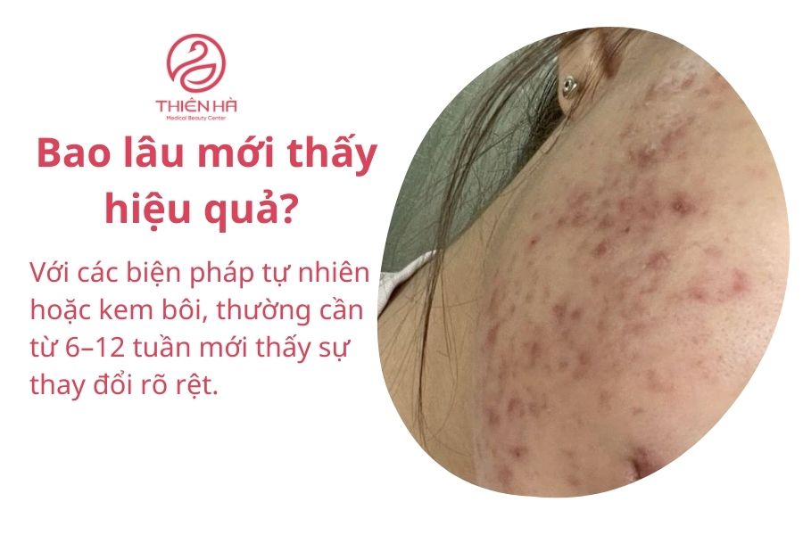 Trị sẹo thâm hiệu quả: Phương pháp tự nhiên, kem bôi và công nghệ y tế 10 Một số câu hỏi thường gặp