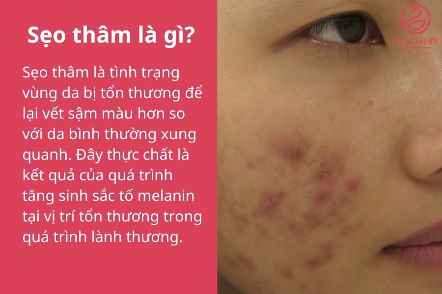 Trị sẹo thâm hiệu quả: Phương pháp tự nhiên, kem bôi và công nghệ y tế 1 Sẹo thâm là gì?