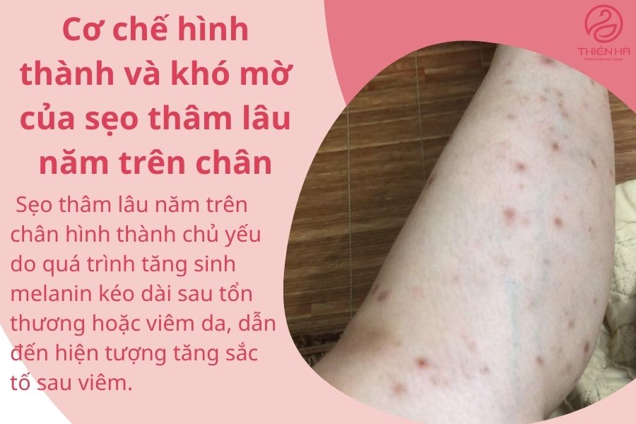 Cơ chế hình thành và khó mờ của sẹo thâm lâu năm trên chân