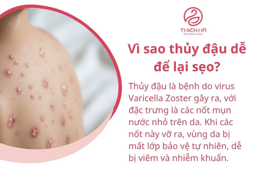 Vì sao thủy đậu dễ để lại sẹo?