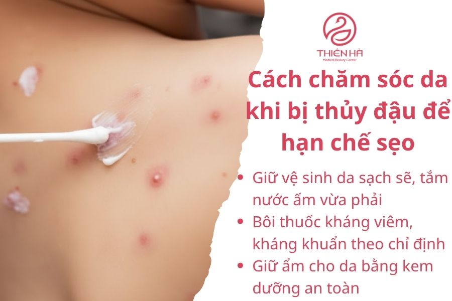 Bôi thuốc kháng viêm, kháng khuẩn theo chỉ định