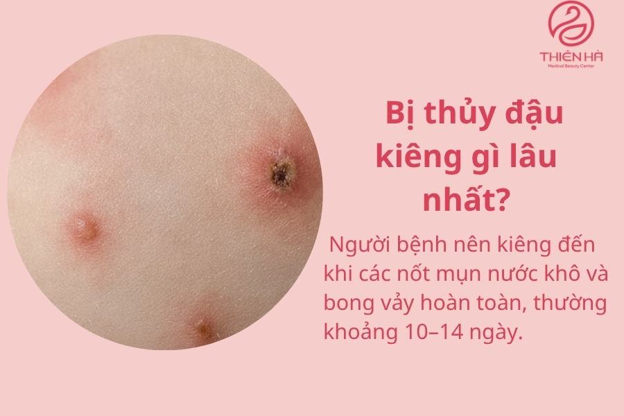 Bị thủy đậu kiêng gì lâu nhất?