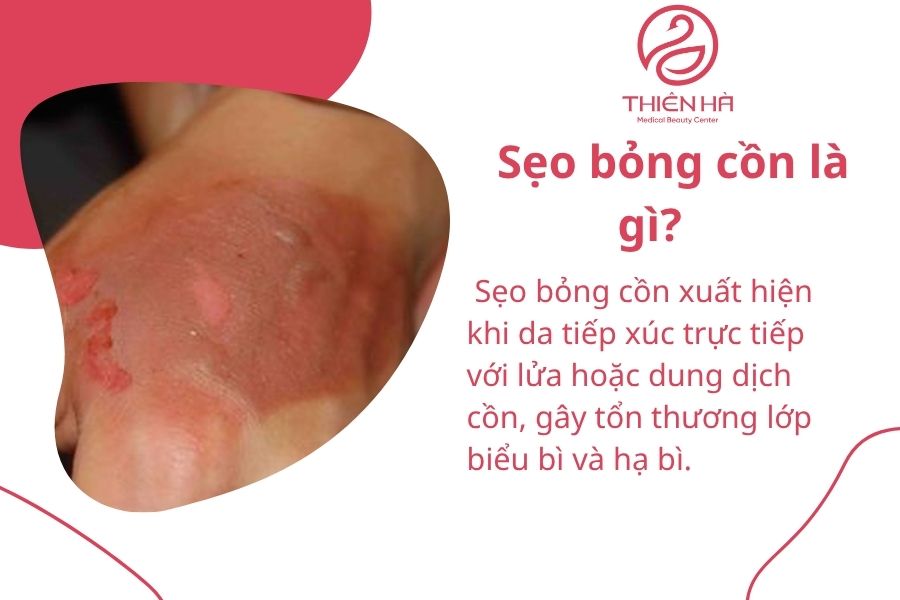Top 10+ cách trị sẹo bỏng cồn nhanh chóng, an toàn tại nhà & spa 1 Sẹo bỏng cồn là gì?
