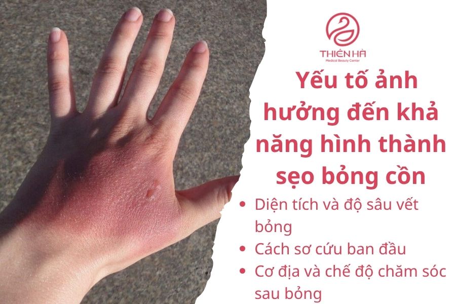 Top 10+ cách trị sẹo bỏng cồn nhanh chóng, an toàn tại nhà & spa 2 Yếu tố ảnh hưởng đến khả năng hình thành sẹo bỏng cồn