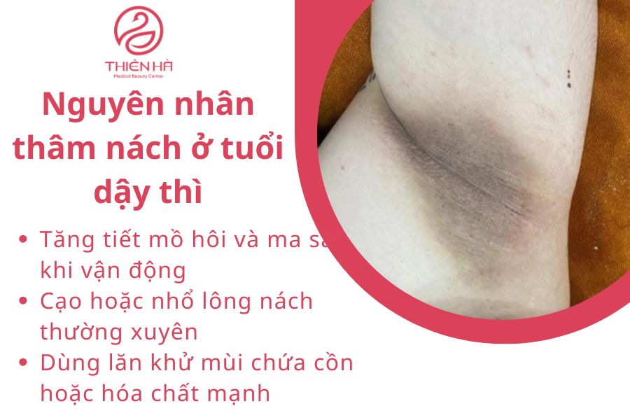 Nguyên nhân thâm nách ở tuổi dậy thì