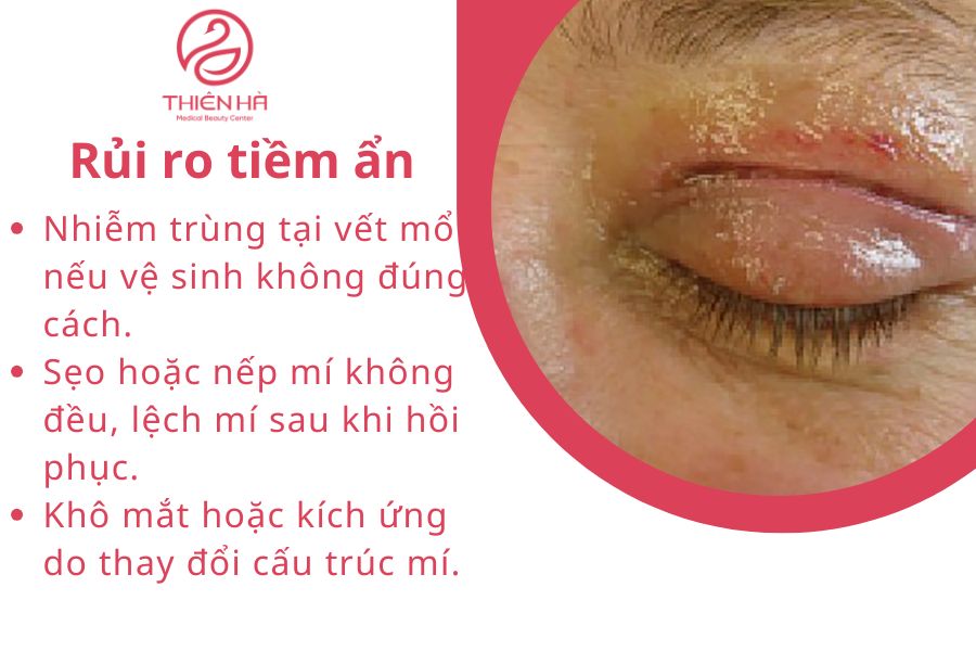 Tìm hiểu cắt mỡ mí mắt: phương pháp, chi phí và rủi ro cần tránh 6 Rủi ro tiềm ẩn