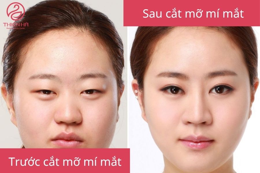 Tìm hiểu cắt mỡ mí mắt: phương pháp, chi phí và rủi ro cần tránh 2 Kết quả sau cắt mỡ mí mắt mang lại đôi mắt tươi sáng
