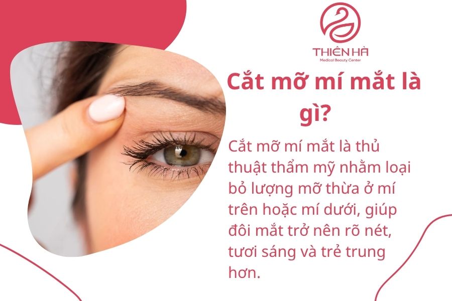 Tìm hiểu cắt mỡ mí mắt: phương pháp, chi phí và rủi ro cần tránh 1 Cắt mỡ mí mắt là gì?