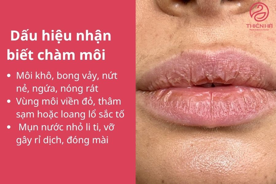 Chàm môi là gì? Nguyên nhân, dấu hiệu và cách điều trị hiệu quả 3 Môi khô, bong vảy, nứt nẻ