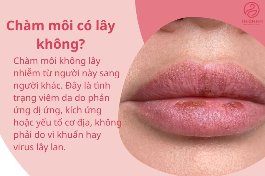 Chàm môi là gì? Nguyên nhân, dấu hiệu và cách điều trị hiệu quả 6 Chàm môi có lây không?