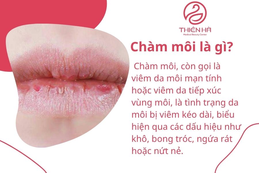 Chàm môi là gì? Nguyên nhân, dấu hiệu và cách điều trị hiệu quả 1 Chàm môi là gì?