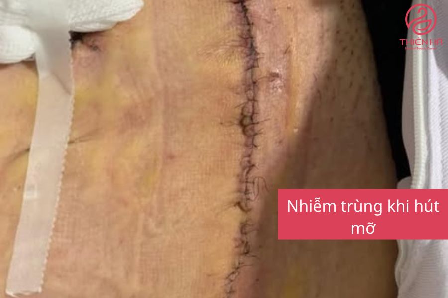 Hút mỡ bao nhiêu tiền? Bảng giá mới nhất và chi phí từng vùng 5 Rủi ro có thể gặp phải