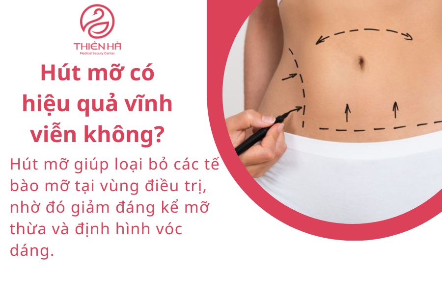 Hút mỡ bao nhiêu tiền? Bảng giá mới nhất và chi phí từng vùng 7 Hút mỡ có hiệu quả vĩnh viễn không?