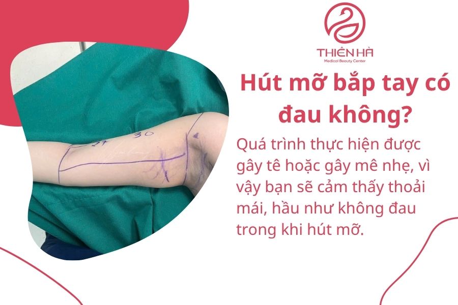 Hút mỡ bắp tay là gì? Quy trình, chi phí và lưu ý an toàn cần biết 9 Một số câu hỏi thường gặp về hút mỡ bắp tay
