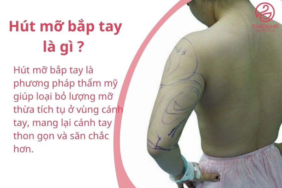 Hút mỡ bắp tay là gì? Quy trình, chi phí và lưu ý an toàn cần biết 1 Hút mỡ bắp tay là gì