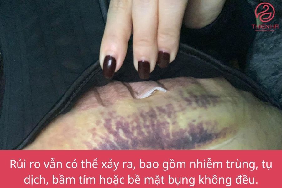 Hút mỡ bụng: Ưu điểm, rủi ro tiềm ẩn và tiêu chí chọn nơi uy tín 5 Rủi ro có thể xảy ra