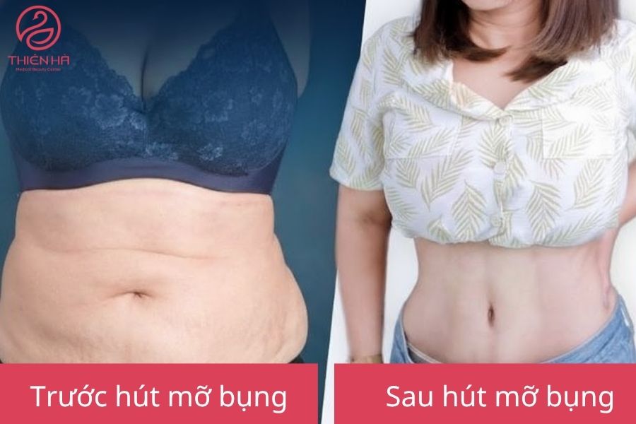 Hút mỡ bụng: Ưu điểm, rủi ro tiềm ẩn và tiêu chí chọn nơi uy tín 4 Kết quả sau hút mỡ bụng