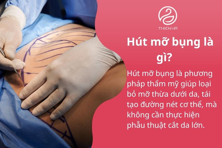 Hút mỡ bụng: Ưu điểm, rủi ro tiềm ẩn và tiêu chí chọn nơi uy tín 1 Hút mỡ bụng là gì?