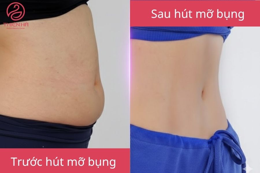 Hút mỡ bụng bao nhiêu tiền? Bảng giá chi tiết mới nhất hiện nay 4 Kết quả của phương pháp hút mỡ bụng