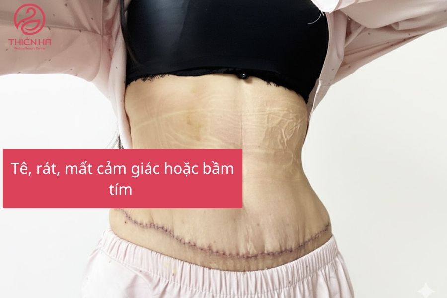 Hút mỡ bụng có nguy hiểm không? Giải đáp từ chuyên gia thẩm mỹ 4 Dấu hiệu biến chứng sau hút mỡ bụng cần lưu ý