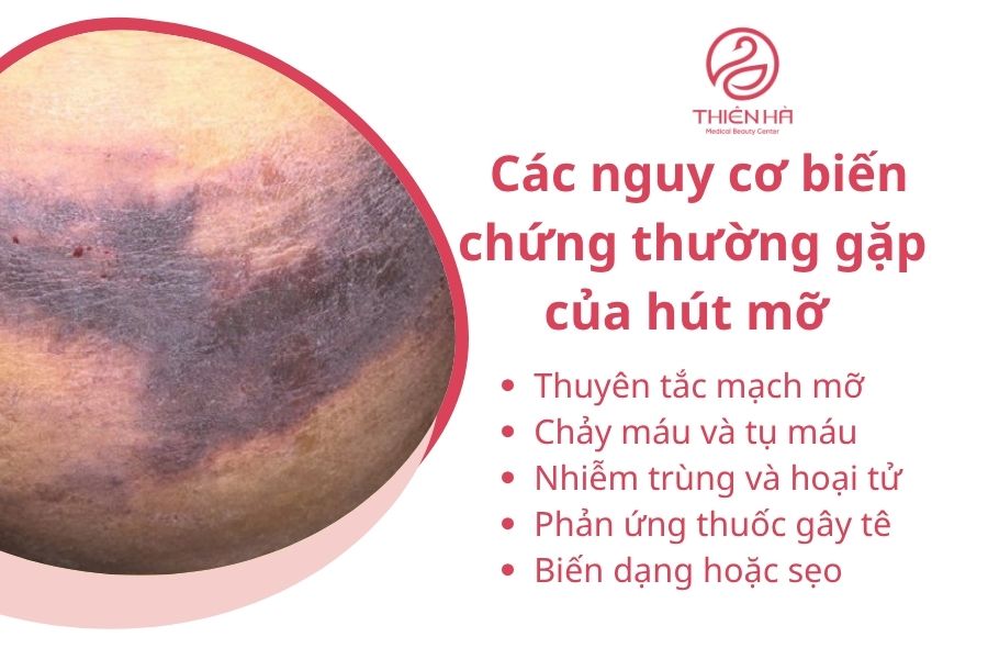 Biến chứng tụ máu của hút mỡ
