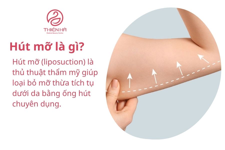 Hút mỡ là gì? 