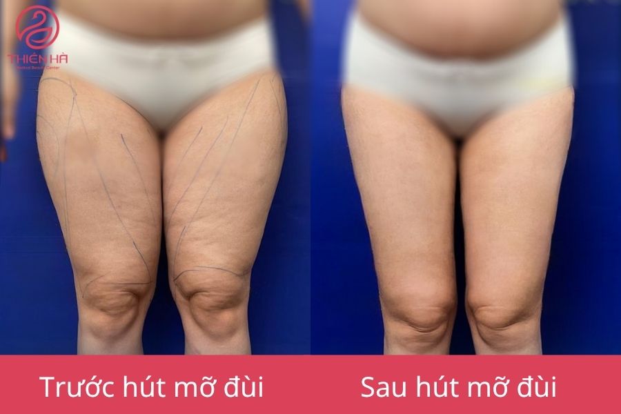 Hút mỡ đùi là gì? Quy trình, chi phí và hiệu quả thực tế 2 Kết quả sau hút mỡ đùi : Cặp đùi thon gọn