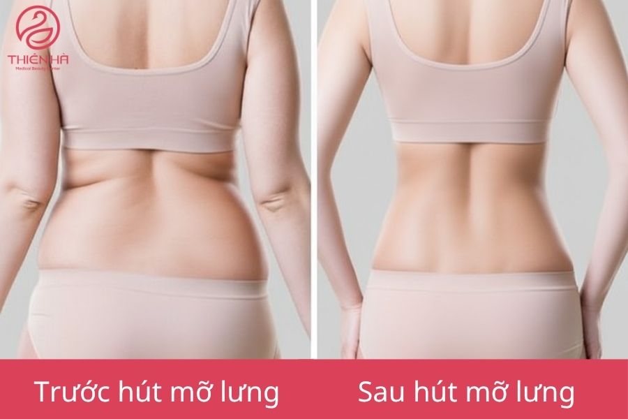 Hút mỡ lưng là gì? Giải pháp giúp tấm lưng phẳng mịn, thon gọn 2 Kết quả sau hút mỡ lưng giúp cải thiện vóc dáng
