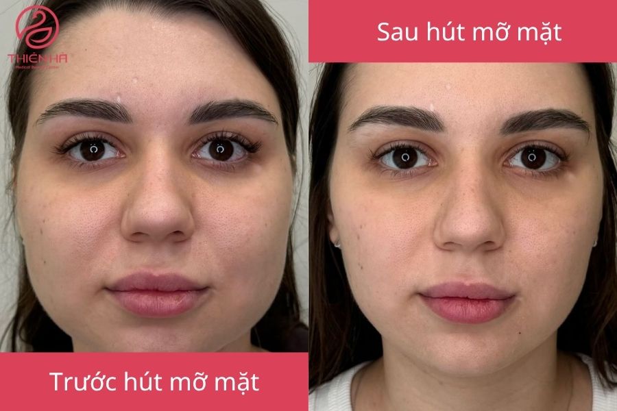 Hút mỡ mặt là gì? Giải pháp thu gọn khuôn mặt nhanh, an toàn 2 Kết quả sau hút mỡ mặt