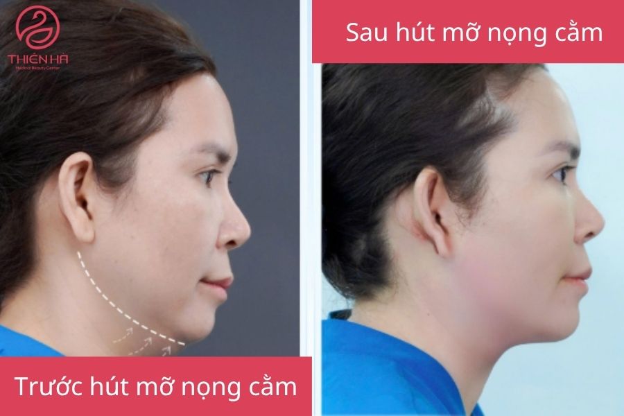 Hút mỡ nọng cằm là gì? Tất tần tật thông tin bạn cần biết 2 Kết quả hút mỡ nọng cằm