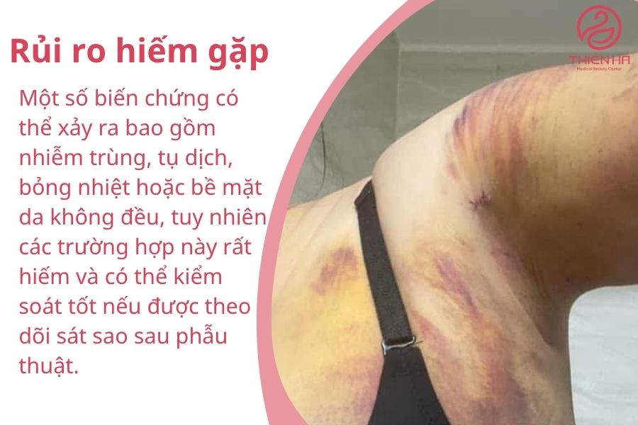 Rủi ro hiếm gặp 