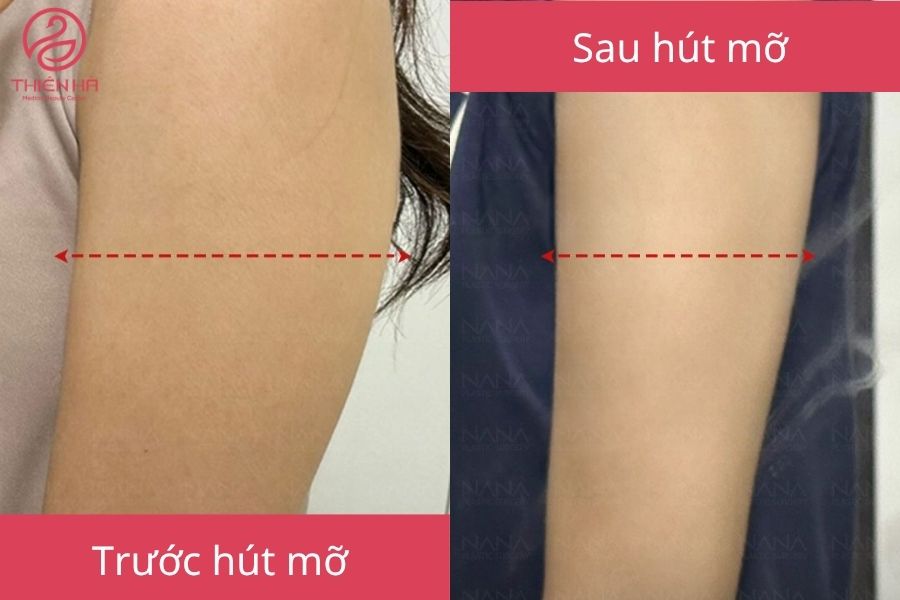 Kết quả khách hàng trước và sau hút mỡ 