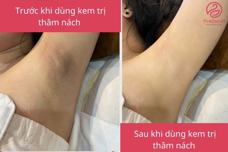 Kết quả sau khi dùng kem trị thâm nách 
