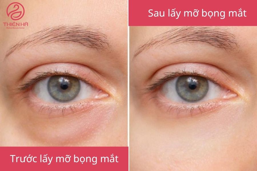 Lấy mỡ bọng mắt giúp đôi mắt trẻ trung tươi sáng