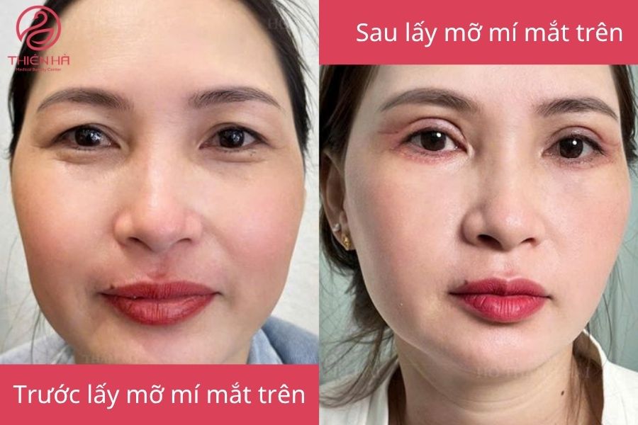 Hình ảnh khách hàng trước và sau láy mỡ mí mắt trên 