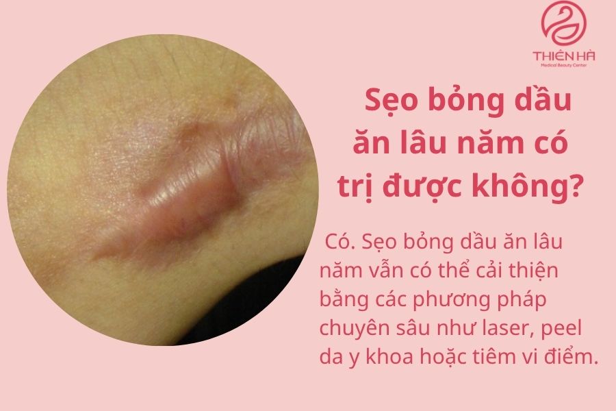 Sẹo bỏng dầu ăn: Giải pháp khắc phục từ dân gian đến công nghệ cao 7 Sẹo bỏng dầu ăn lâu năm có trị được không ?