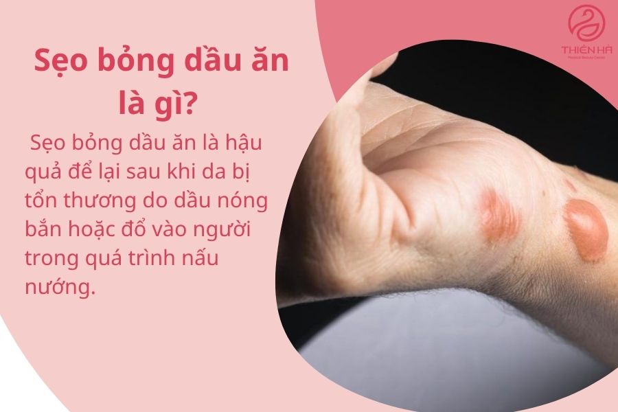 Sẹo bỏng dầu ăn: Giải pháp khắc phục từ dân gian đến công nghệ cao 1 Khái niệm về sẹo bỏng dầu ăn
