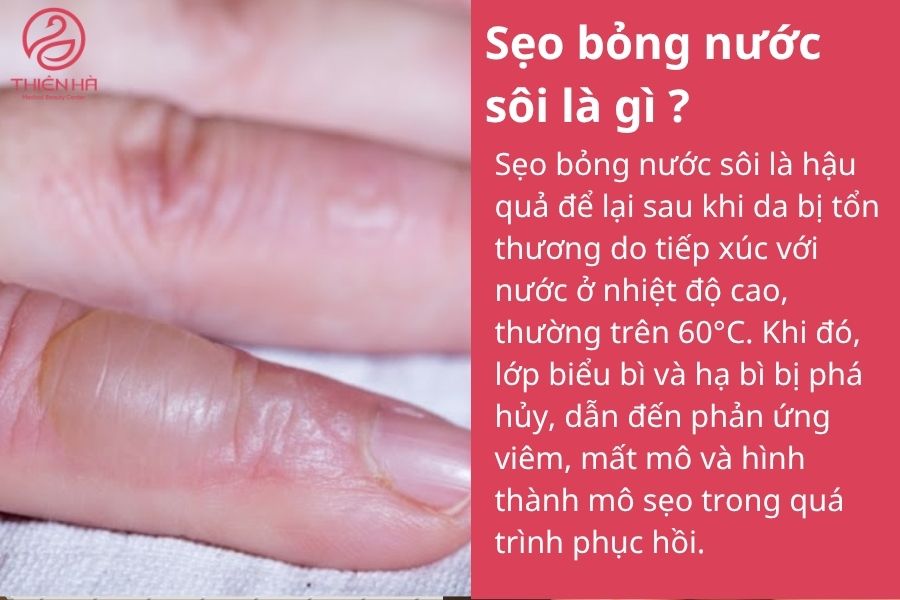 Cách xóa sẹo bỏng nước sôi an toàn, được Viện Thẩm Mỹ Thiên Hà tư vấn 1 Sẹo bỏng nước sôi là gì ?