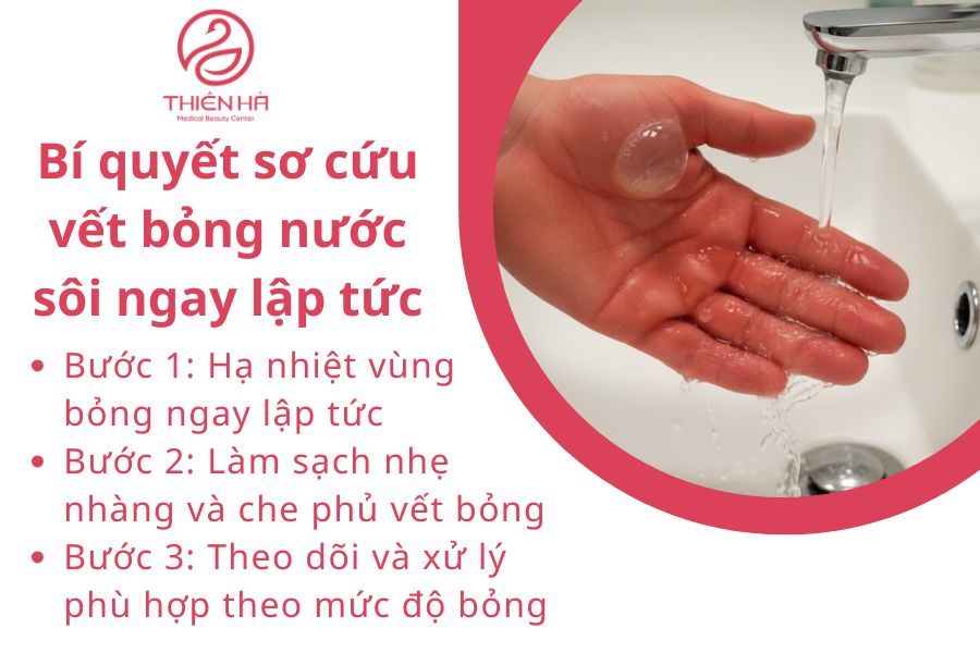 Cách xóa sẹo bỏng nước sôi an toàn, được Viện Thẩm Mỹ Thiên Hà tư vấn 2 Bí quyết sơ cứu vết bỏng nước sôi ngay lập tức để hạn chế sẹo tối đa