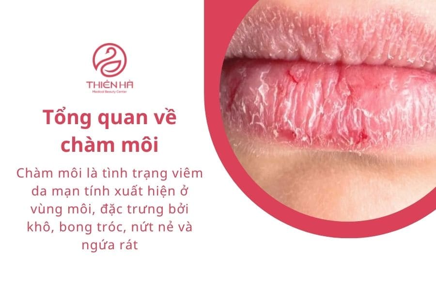 Top 7 thuốc bôi chàm môi hiệu quả, an toàn được bác sĩ khuyên dùng 1 Tổng quan về chàm môi